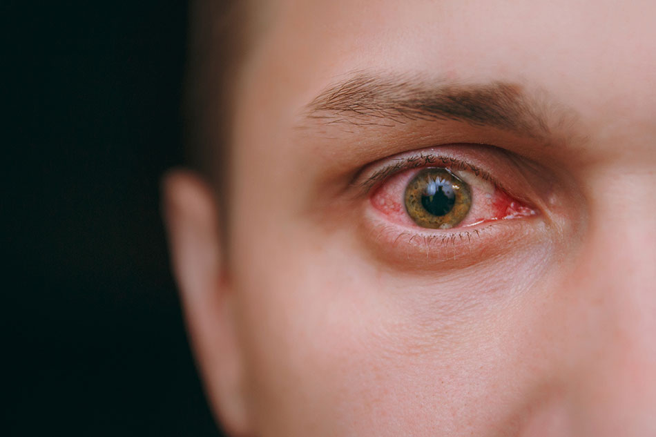 close up of dry eye syndrome