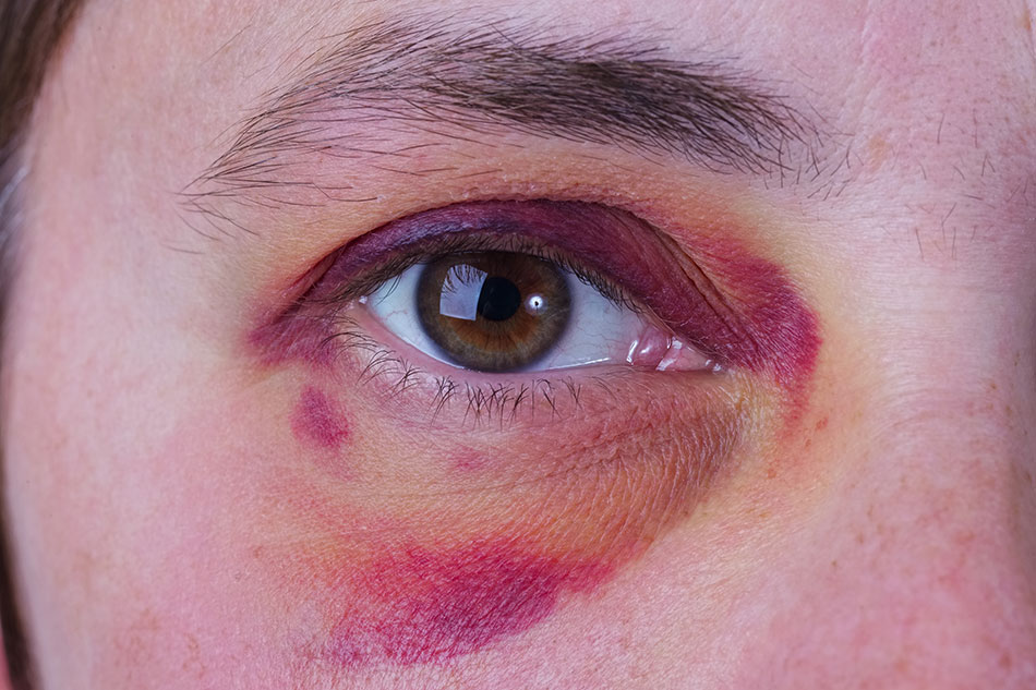 Close-up of swollen bruised eye
