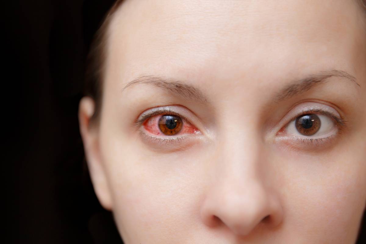 Close-up of woman with eye infection