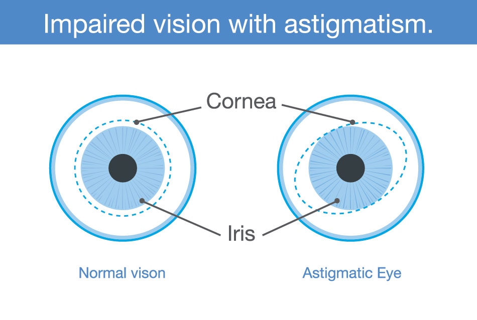 diagram showing impaired vision with astigmatism