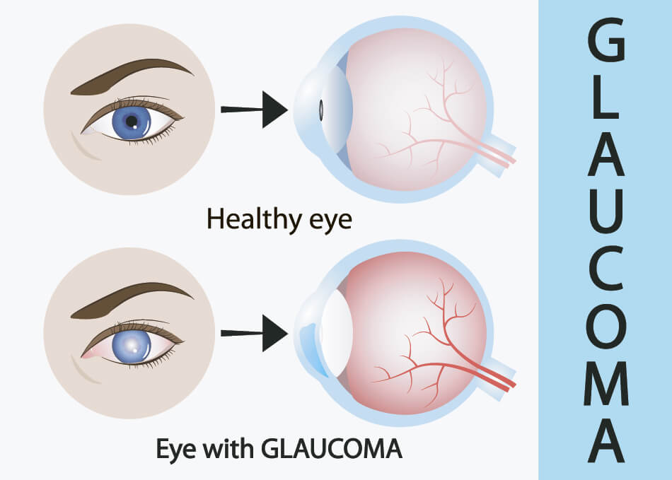 diagram of eyes with and without glaucoma