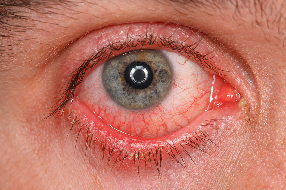 Close up eye infection