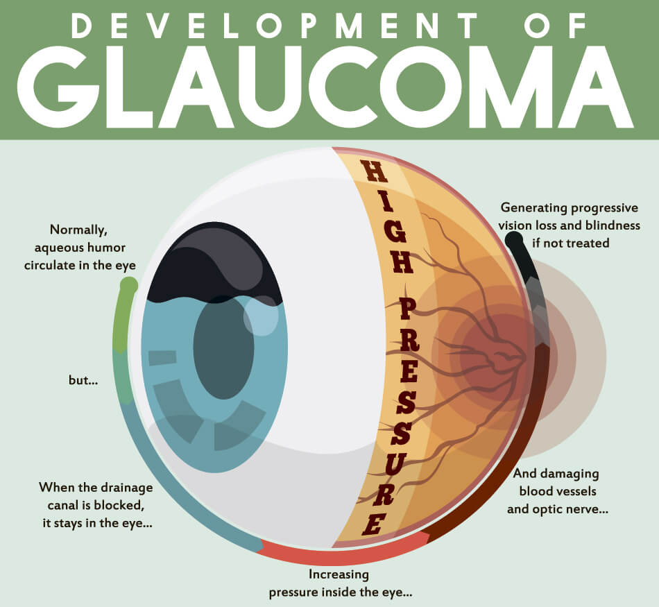 diagram explaining the development of glaucoma