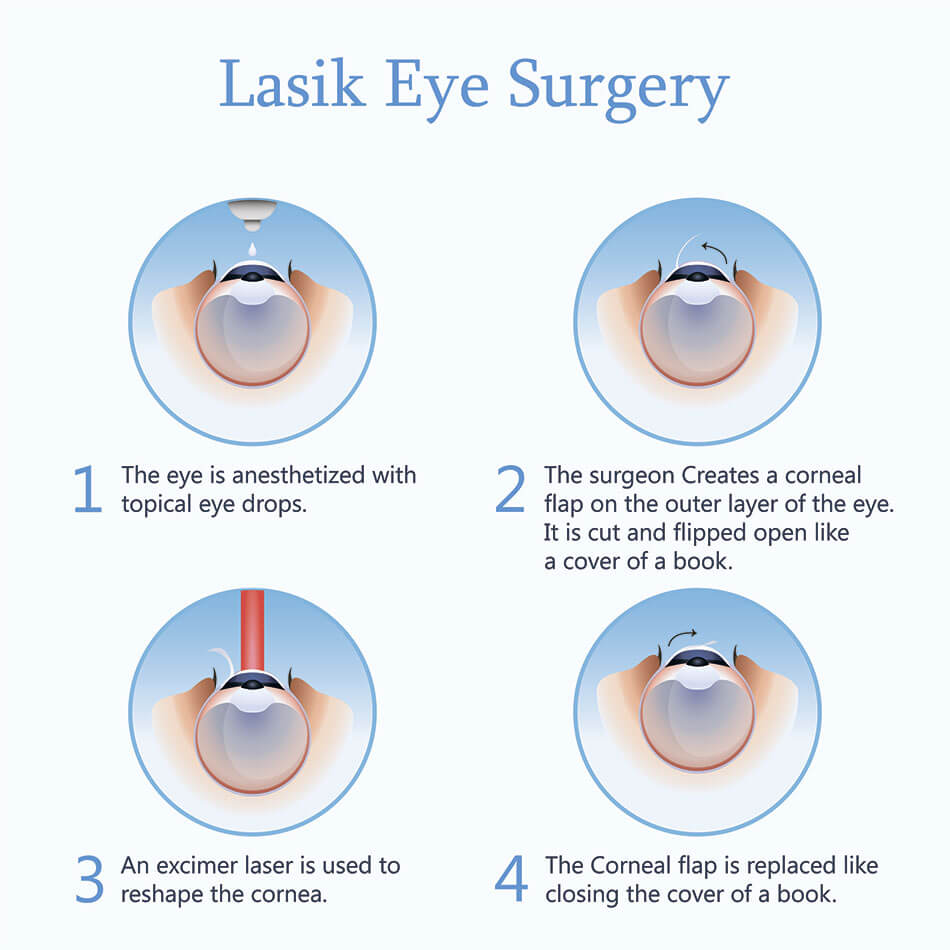 Diagram showing lasik eye surgery steps