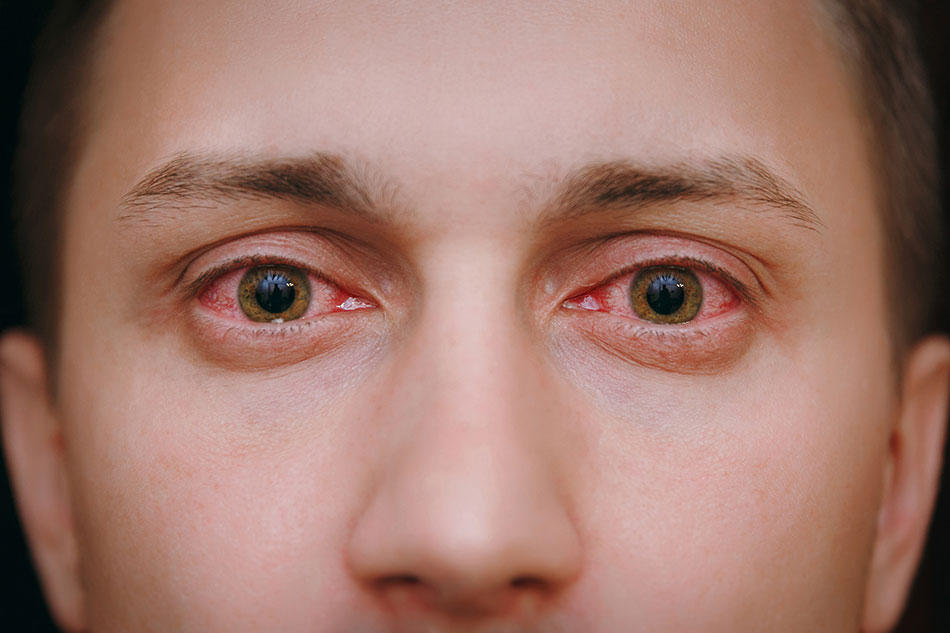 man with conjunctivitis