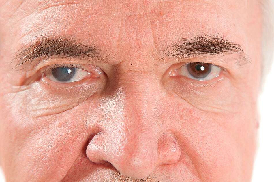 man with cataract in his right eye