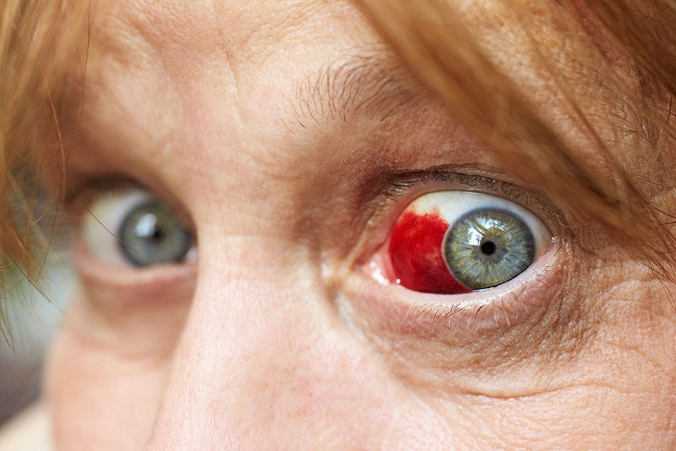 Senior woman with eye bleed close-up