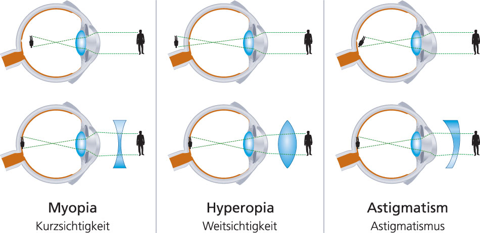 types of eye conditions with eye and lens