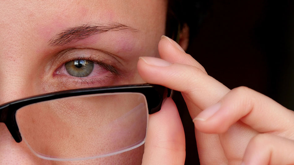 woman with red eye taking off black glasses