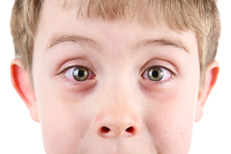 Young boy with conjunctivitis